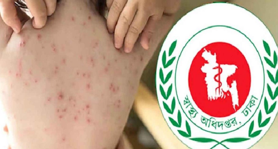হামের উপসর্গ নিয়ে আরও ১০ শিশুর মৃত্যু